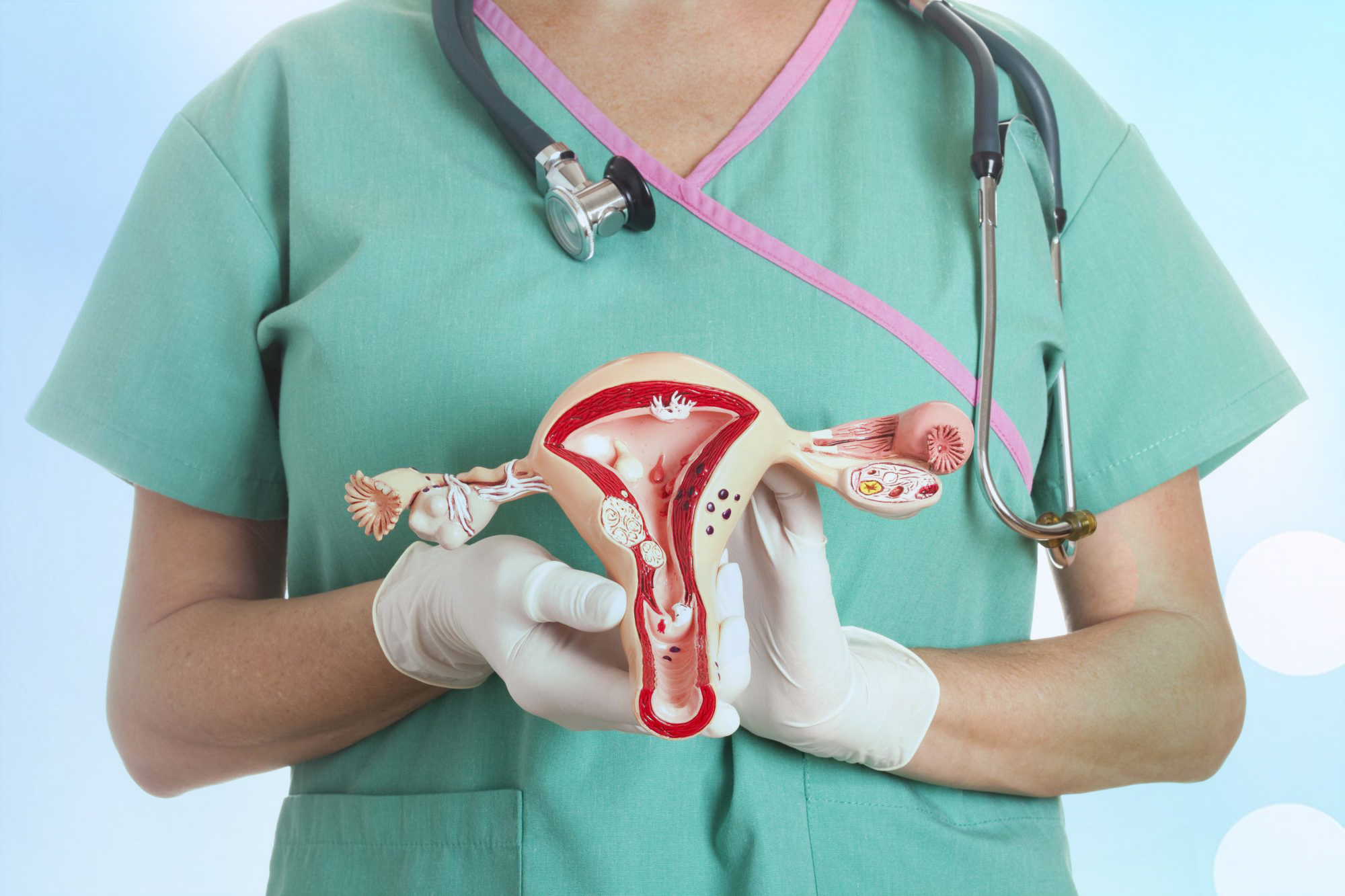 mioma_uterino_e1511827537461_1